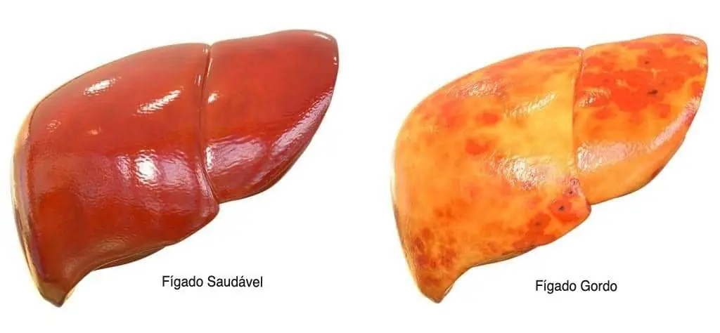 fígado gordo versus fígado normal