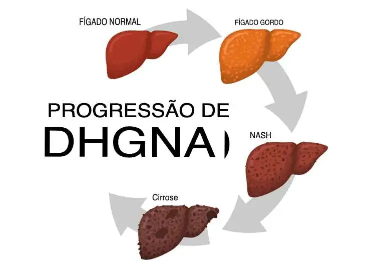 evolução da esteatose em esteatohepatite e em seguida em cirrose